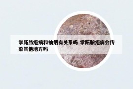 掌跖膿皰病和抽煙有關(guān)系嗎 掌跖膿皰病會(huì)傳染其他地方嗎