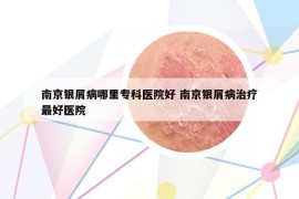 南京銀屑病哪里?？漆t(yī)院好 南京銀屑病治療最好醫(yī)院
