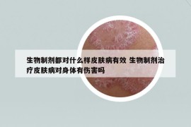 生物制劑都對什么樣皮膚病有效 生物制劑治療皮膚病對身體有傷害嗎