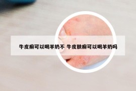 牛皮癬可以喝羊奶不 牛皮膚癬可以喝羊奶嗎