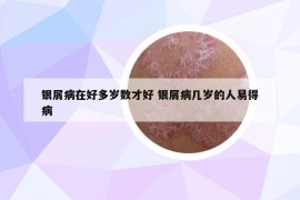 銀屑病在好多歲數(shù)才好 銀屑病幾歲的人易得病