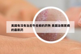 美國有沒有治愈牛皮癬的藥物 美國治銀屑病的最新藥