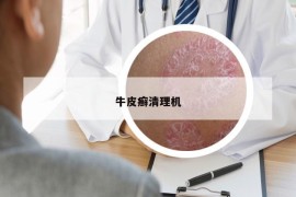 牛皮癬清理機(jī)