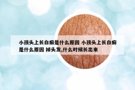 小孩頭上長(zhǎng)白癬是什么原因 小孩頭上長(zhǎng)白癬是什么原因 掉頭發(fā),什么時(shí)候長(zhǎng)出來(lái)