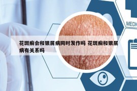花斑癬會和銀屑病同時發(fā)作嗎 花斑癬和銀屑病有關(guān)系嗎