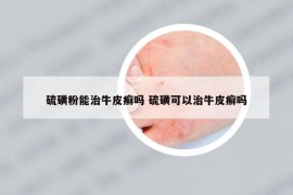 硫磺粉能治牛皮癬嗎 硫磺可以治牛皮癬嗎