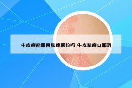 牛皮癬能服用膚癢顆粒嗎 牛皮膚癬口服藥