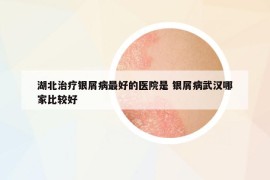 湖北治療銀屑病最好的醫(yī)院是 銀屑病武漢哪家比較好