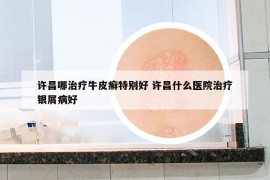 許昌哪治療牛皮癬特別好 許昌什么醫(yī)院治療銀屑病好