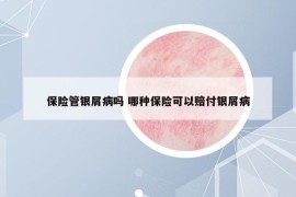 保險(xiǎn)管銀屑病嗎 哪種保險(xiǎn)可以賠付銀屑病