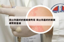 周口市最好的銀屑病專家 周口市最好的銀屑病專家是誰