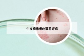 牛皮癬患者吃菜花好嗎