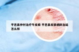 平邑縣仲村治療牛皮癬 平邑縣皮膚病防治站怎么樣