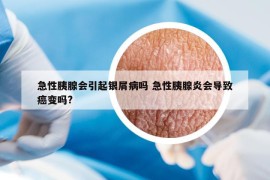 急性胰腺會(huì)引起銀屑病嗎 急性胰腺炎會(huì)導(dǎo)致癌變嗎?