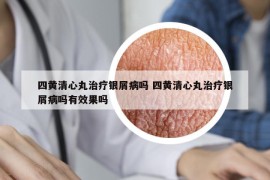 四黃清心丸治療銀屑病嗎 四黃清心丸治療銀屑病嗎有效果嗎