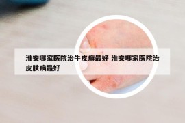 淮安哪家醫(yī)院治牛皮癬最好 淮安哪家醫(yī)院治皮膚病最好