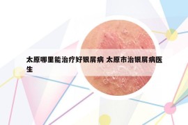太原哪里能治療好銀屑病 太原市治銀屑病醫(yī)生