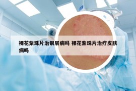裸花紫珠片治銀屑病嗎 裸花紫珠片治療皮膚病嗎