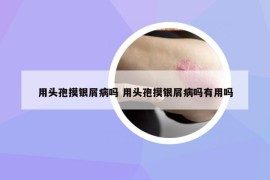 用頭孢摸銀屑病嗎 用頭孢摸銀屑病嗎有用嗎