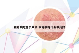 銀著病吃什么草藥 銀霄病吃什么中藥好