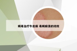 蝎毒治療牛皮癬 毒蝎癬清的功效