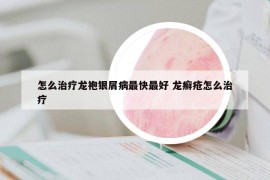 怎么治療龍袍銀屑病最快最好 龍癬瘡怎么治療