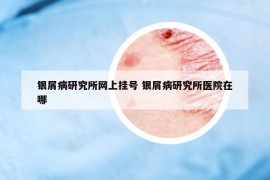 銀屑病研究所網(wǎng)上掛號(hào) 銀屑病研究所醫(yī)院在哪