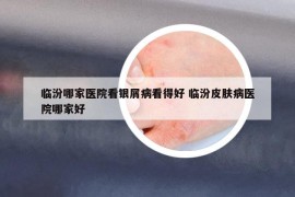 臨汾哪家醫(yī)院看銀屑病看得好 臨汾皮膚病醫(yī)院哪家好