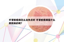 手掌膿皰病怎么治快點好 手掌膿皰病是什么原因來的呢?