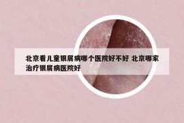 北京看兒童銀屑病哪個(gè)醫(yī)院好不好 北京哪家治療銀屑病醫(yī)院好