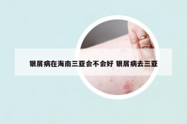 銀屑病在海南三亞會不會好 銀屑病去三亞