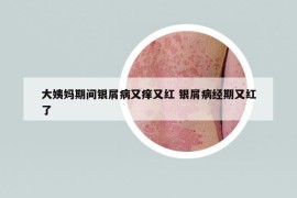 大姨媽期間銀屑病又癢又紅 銀屑病經(jīng)期又紅了