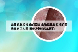 去胎記比較權(quán)威的醫(yī)院 去胎記比較權(quán)威的醫(yī)院北京衛(wèi)人醫(yī)院胎記?？圃趺搭A(yù)約