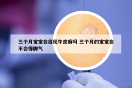 三個月寶寶會出現(xiàn)牛皮癬嗎 三個月的寶寶會不會得腳氣