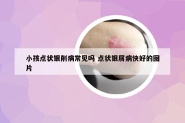 小孩點(diǎn)狀銀削病常見嗎 點(diǎn)狀銀屑病快好的圖片