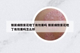 銀屑病擦紫花地丁有效果嗎 銀屑病擦紫花地丁有效果嗎怎么樣
