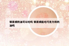 銀屑病奶油可以吃嗎 銀屑病能吃巧克力和奶油嗎
