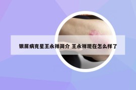 銀屑病克星王永祥簡(jiǎn)介 王永祥現(xiàn)在怎么樣了