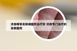 濟(jì)南哪家皮膚病醫(yī)院治療好 濟(jì)南專門治療的皮膚醫(yī)院