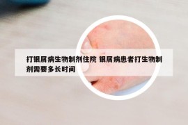 打銀屑病生物制劑住院 銀屑病患者打生物制劑需要多長時間