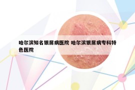 哈爾濱知名銀屑病醫(yī)院 哈爾濱銀屑病?？铺厣t(yī)院