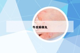 牛皮癬睪丸