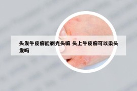 頭發(fā)牛皮癬能剃光頭嘛 頭上牛皮癬可以染頭發(fā)嗎
