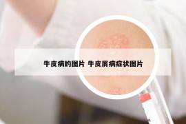 牛皮病的圖片 牛皮屑病癥狀圖片