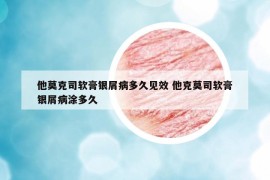 他莫克司軟膏銀屑病多久見(jiàn)效 他克莫司軟膏銀屑病涂多久