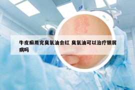 牛皮癬用完臭氧油會(huì)紅 臭氧油可以治療銀屑病嗎