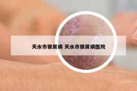 天水市銀屑病 天水市銀屑病醫(yī)院
