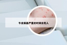 牛皮癬最嚴(yán)重的時(shí)候會(huì)死人