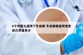 6個月嬰兒遺傳了牛皮癬 牛皮膚癬遺傳寶寶的幾率是多少