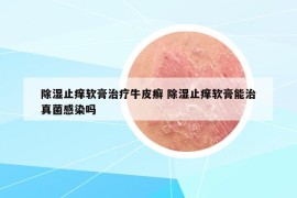 除濕止癢軟膏治療牛皮癬 除濕止癢軟膏能治真菌感染嗎